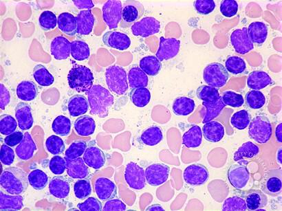 Chronic Lymphocytic Leukaemia
